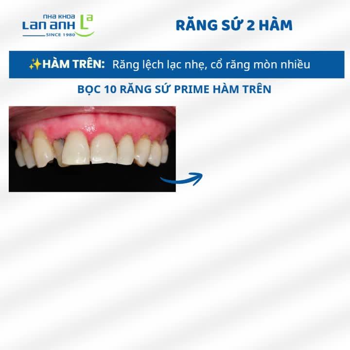 RĂNG LỆCH NHẸ - KHÔNG PHẢI AI CŨNG CẦN CHỈNH NHA