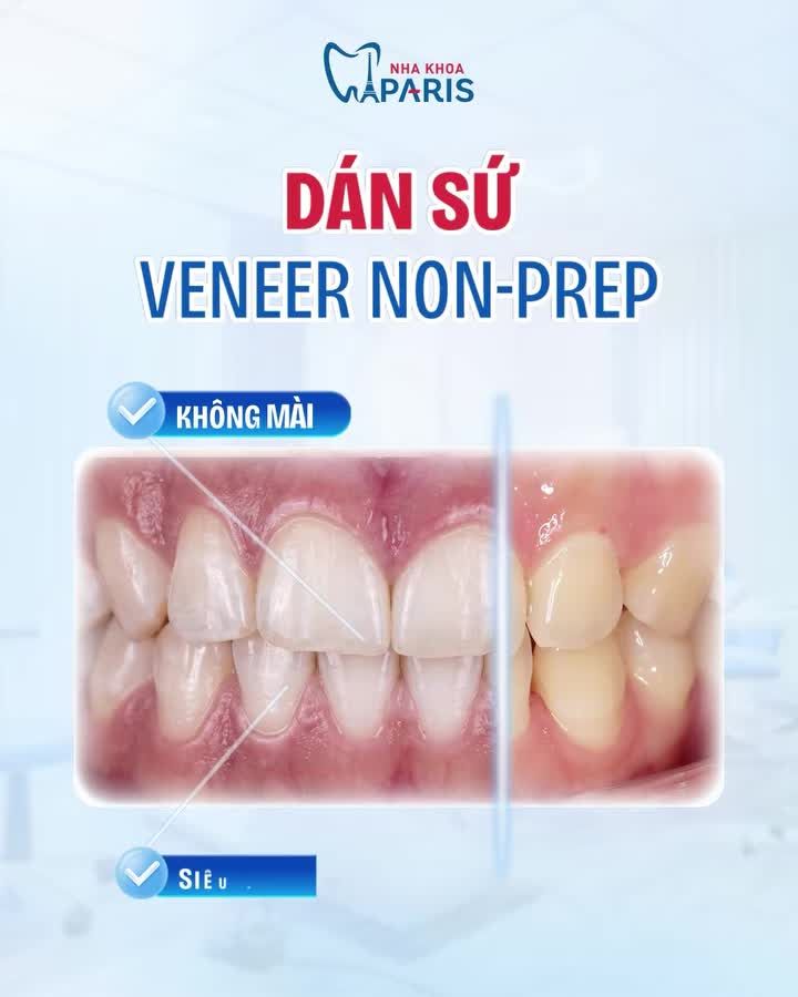 DÁN SỨ VENEER NON-PREP - TÂN TRANG NỤ CƯỜI RẠNG RỠ