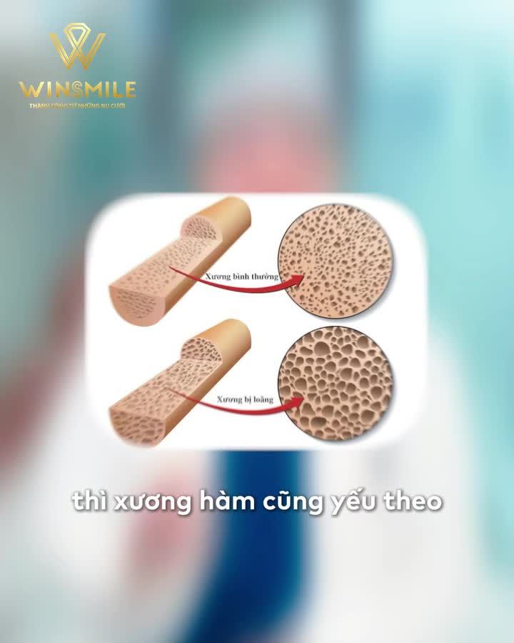 Loãng xương không đồng nghĩa mất đi cơ hội trồng răng implant