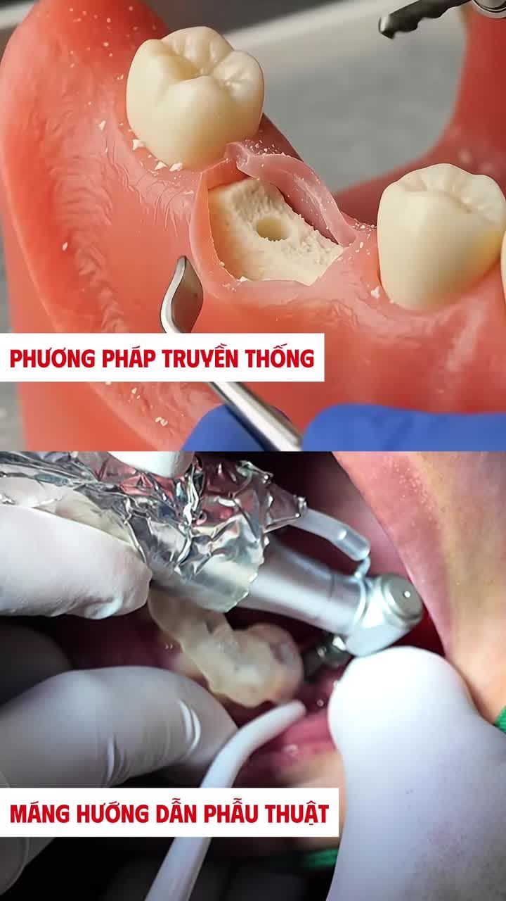 TRỒNG RĂNG IMPLANT KHÔNG CẦN RẠCH VẠT LỢI: BƯỚC TIẾN Y KHOA TẠI NHA KHOA VÂN ANH!