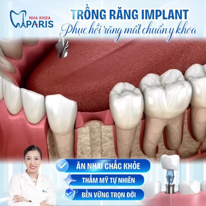 KHÁM PHÁ NGAY GIẢI PHÁP PHỤC HÌNH RĂNG MẤT HÀNG ĐẦU HIỆN NAY!