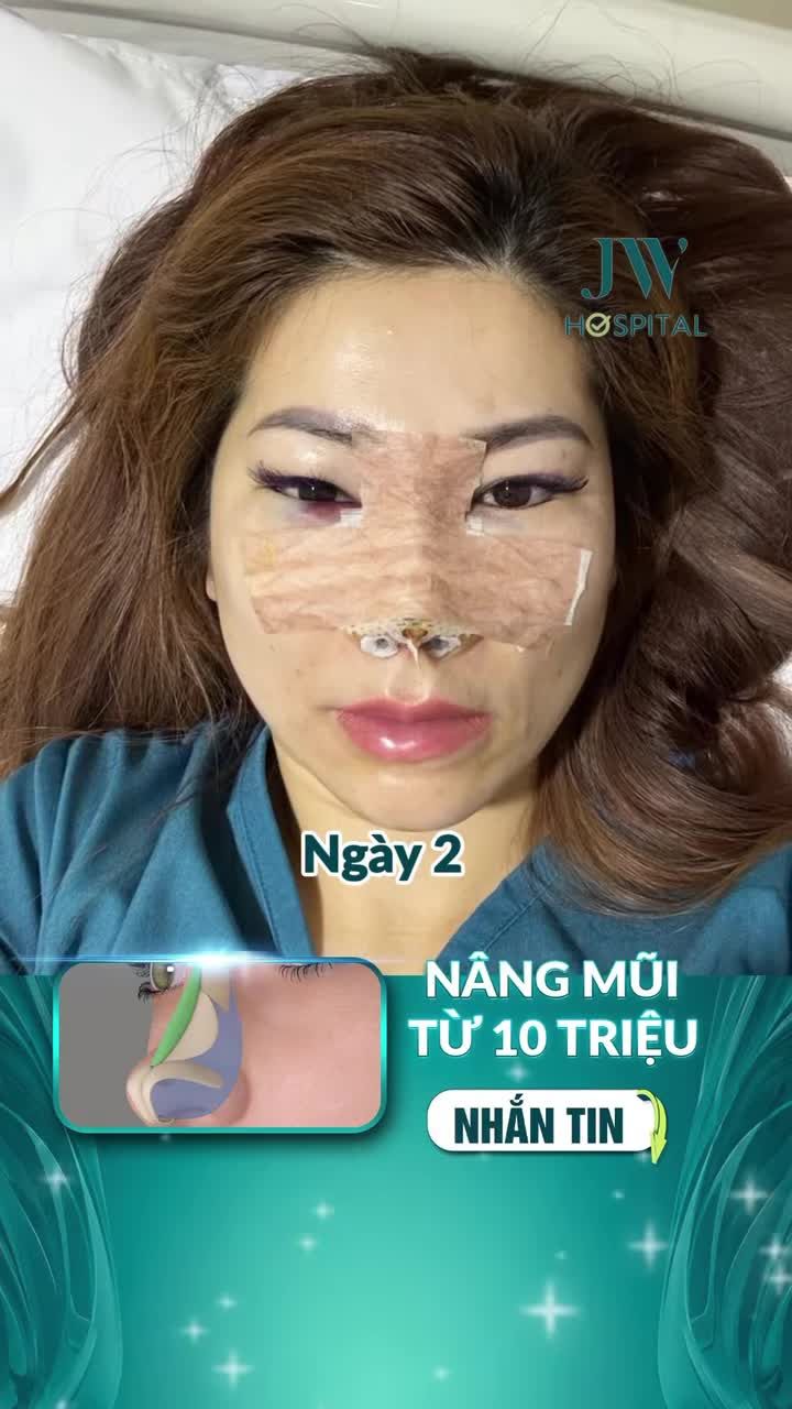SỐC: NỮ VIỆT KIỀU MỸ U50 HỐI HẬN KHI ĐẾN JW NÂNG MŨI S LINE 3D