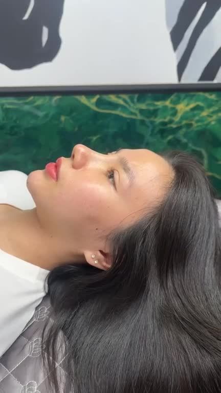 Mũi cấu trúc rút chỉ sau 10 ngày