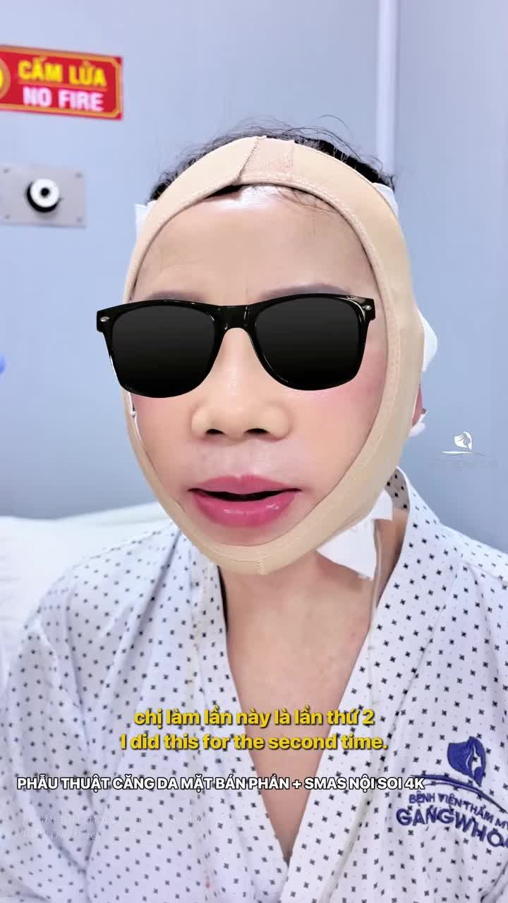 Sau một tháng làm căng da mặt vùng 4,5 khách hàng quay lại làm vùng số 6 bởi thấy được kết quả và chất lượng dịch vụ tại Bệnh viện thẩm mỹ Gangwhoo.