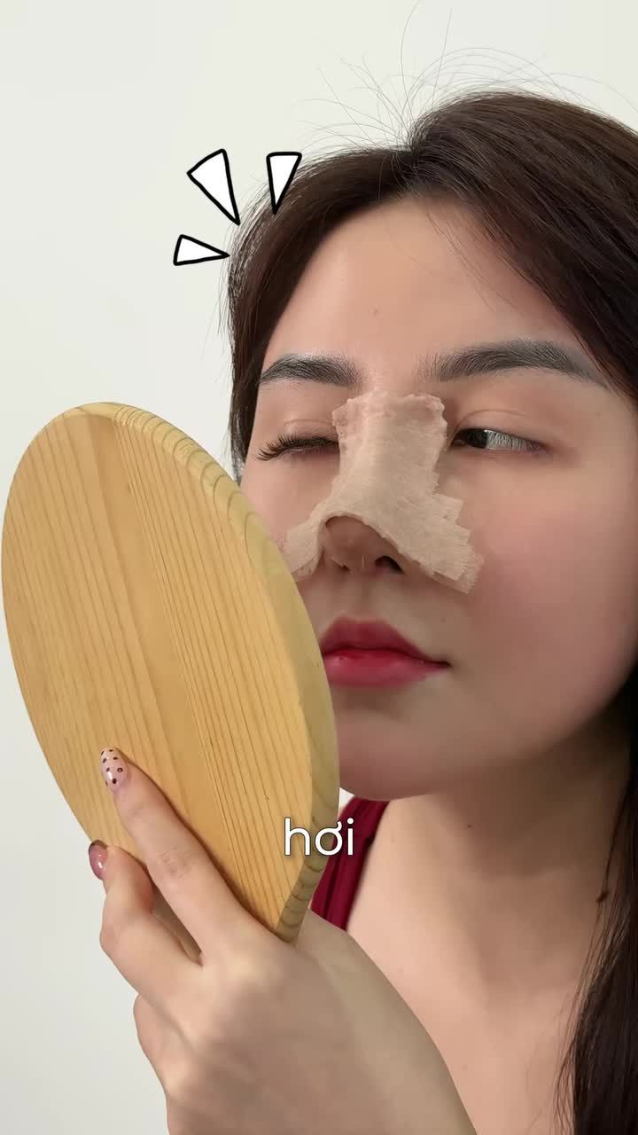 TỪNG NÂNG MŨI CHỈ NHƯNG KHÔNG ƯNG Ý – QUYẾT ĐỊNH SỬA LẠI VÀ CÁI KẾT SAU 10 NGÀY
