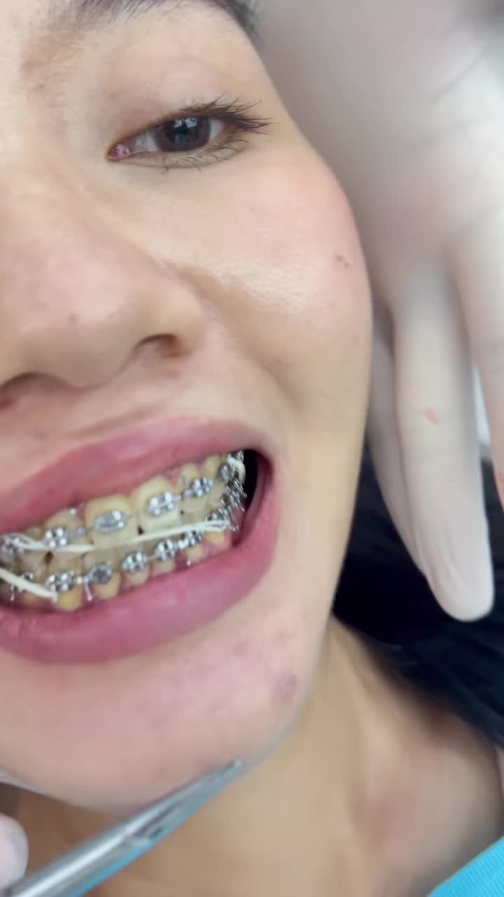 GƯƠNG MẶT LỆCH KHÔNG CHỈ DO XƯƠNG – ĐÔI KHI LÀ DO RĂNG!