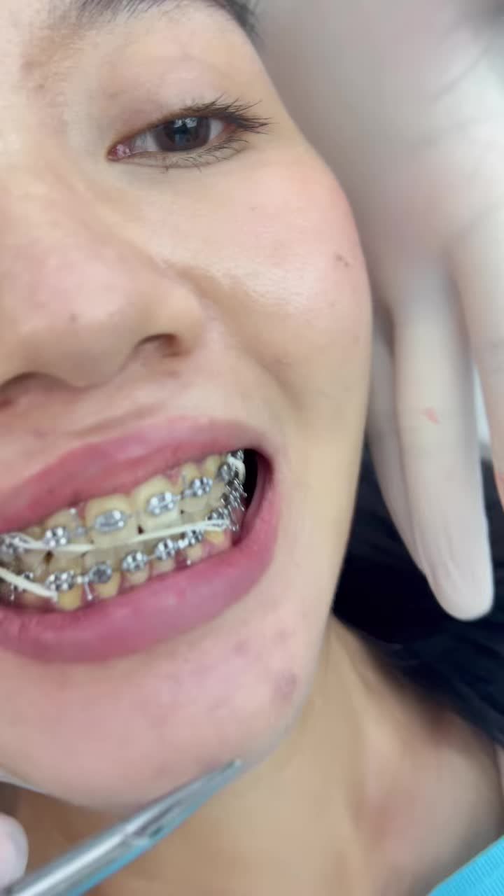 GƯƠNG MẶT LỆCH KHÔNG CHỈ DO XƯƠNG – ĐÔI KHI LÀ DO RĂNG!