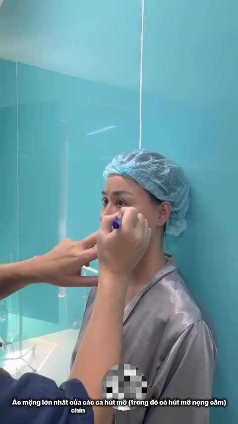 “Hút mỡ mà KO phải nặn dịch - Ít sưng bầm tím” – Kỹ thuật hút mỡ độc quyền chỉ có tại Dr Vương!