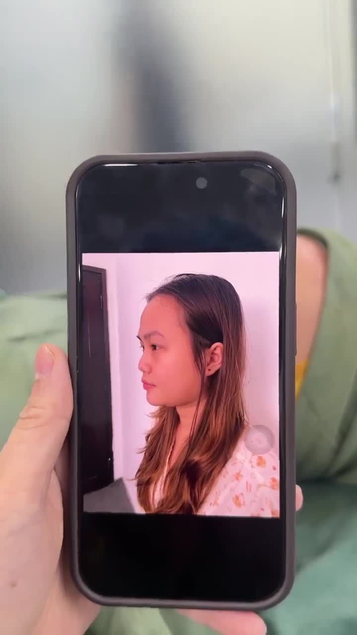 KẾT QUẢ SAU 60 PHÚT NÂNG MŨI CẤU TRÚC - SỬA LẠI MŨI HỎNG CHO BẠN KHÁCH HÀNG GEN Z