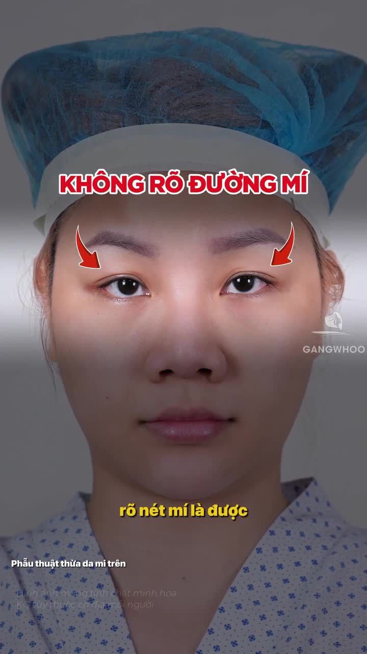Mong muốn của khách hàng ngày hôm nay khi cắt mí