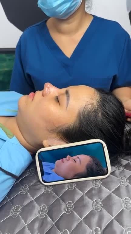 Mũi cấu trúc sửa lại sur sau phẫu thuật