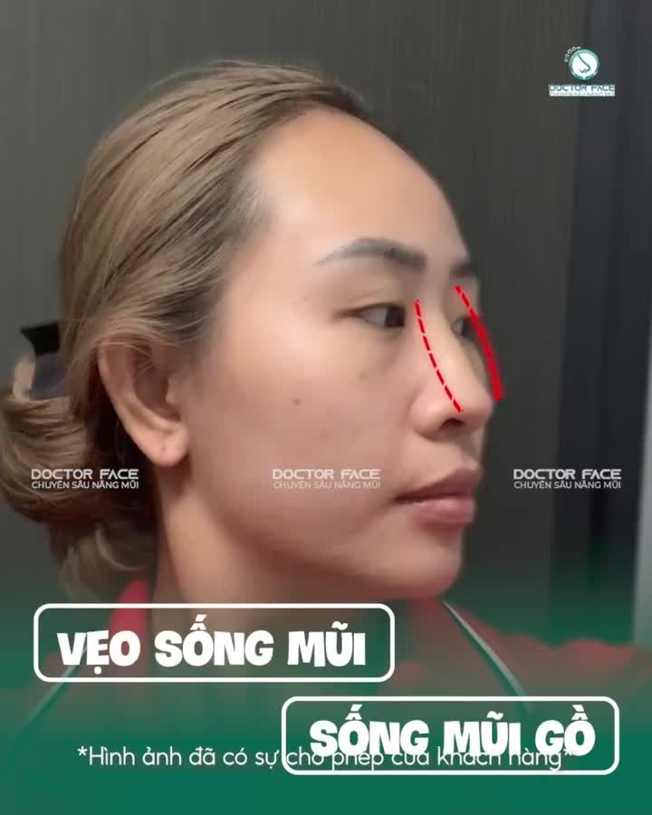 Sống mũi bị lệch nhưng chưa biết nên chỉnh thế nào? Bạn khách này chỉ cần video call là đã được bác sĩ tư vấn trực tiếp rồi nè.