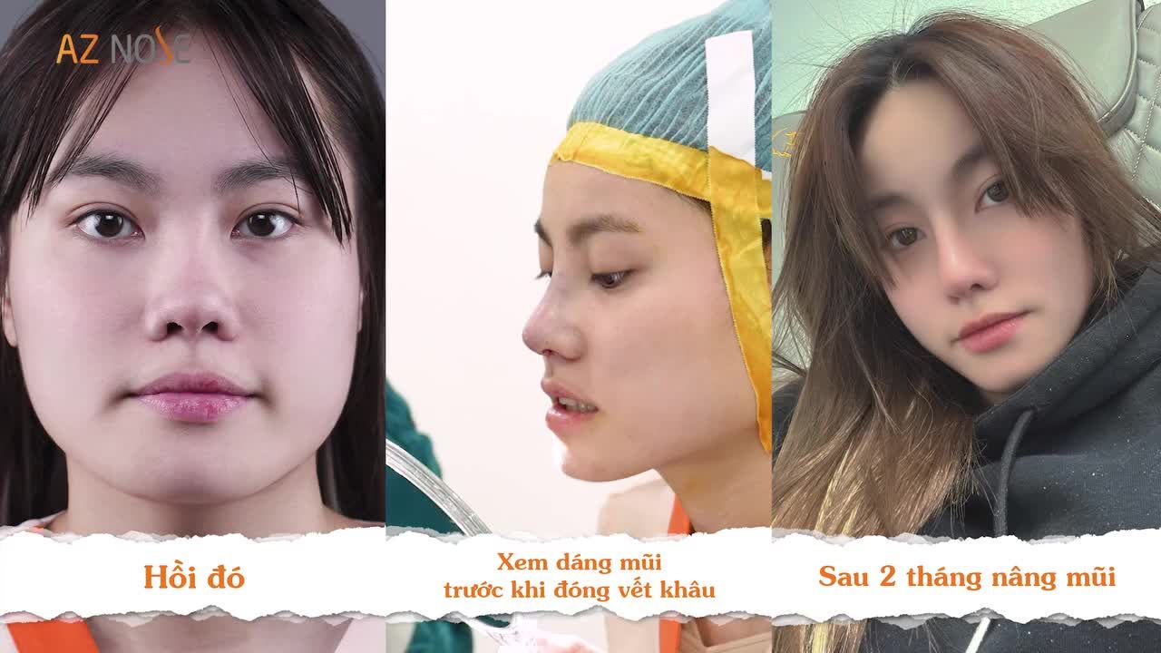 GenZ đến từ USA tự tin selfie mọi góc mặt sau 2 tháng nâng mũi cấu trúc.