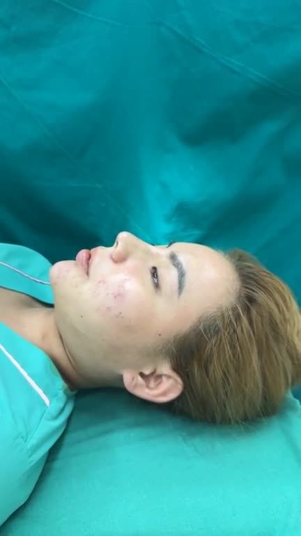 Mũi bọc sụn sau phẫu thuật