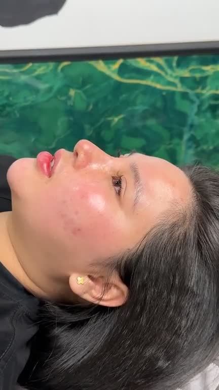 Mũi cấu sửa lại sau 10 ngày