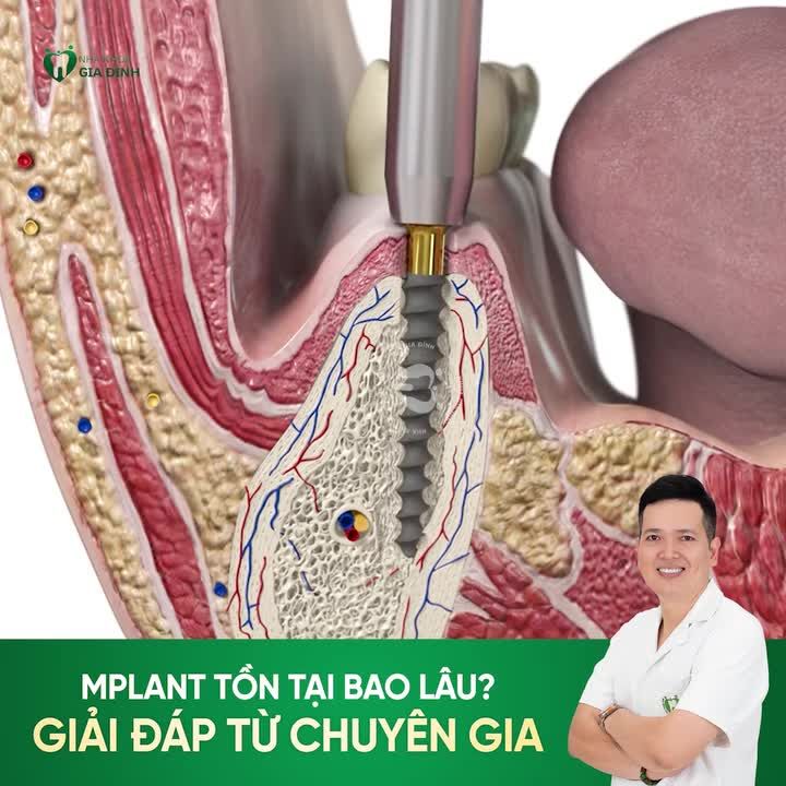 IMPLANT TỒN TẠI ĐƯỢC BAO LÂU?