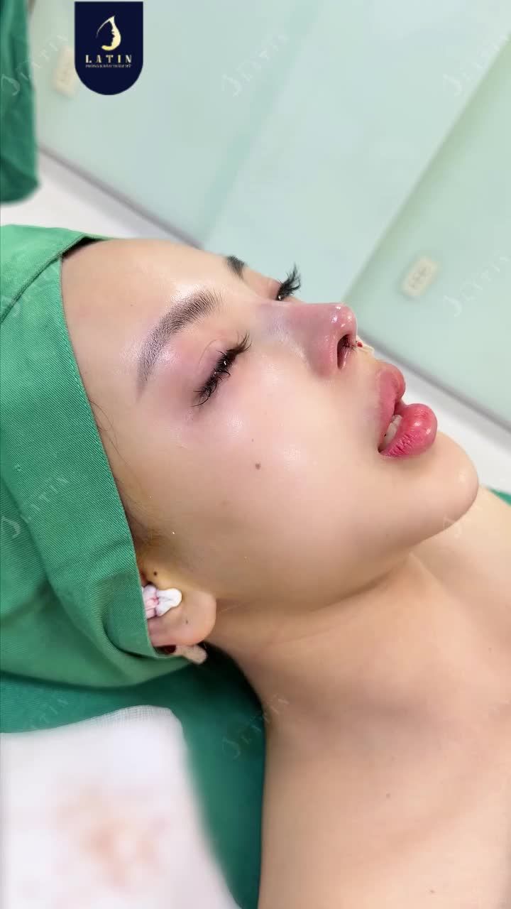 LẤY CHỈ MŨI CŨ – "LÊN ĐỜI" MŨI BAY CẤU TRÚC