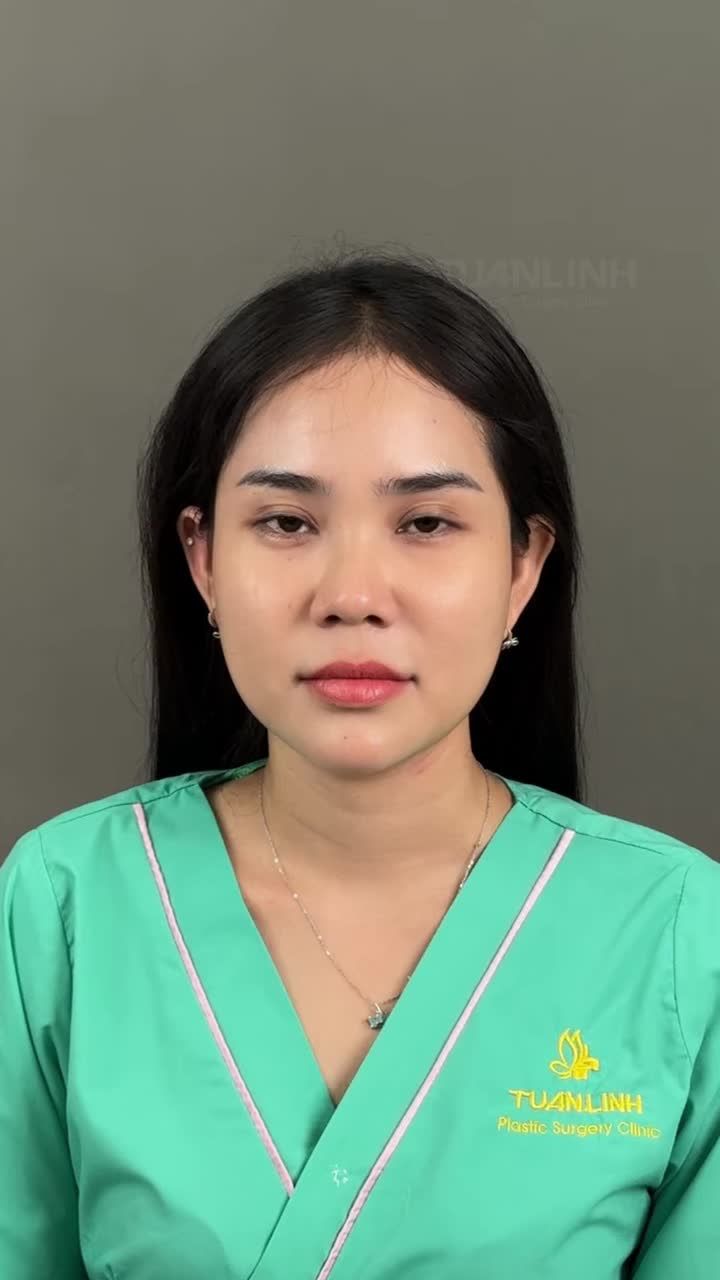 NÂNG MŨI CẤU TRÚC DÁNG THIẾT KẾ – ĐẸP XUẤT SẮC NGAY SAU PHẪU THUẬT