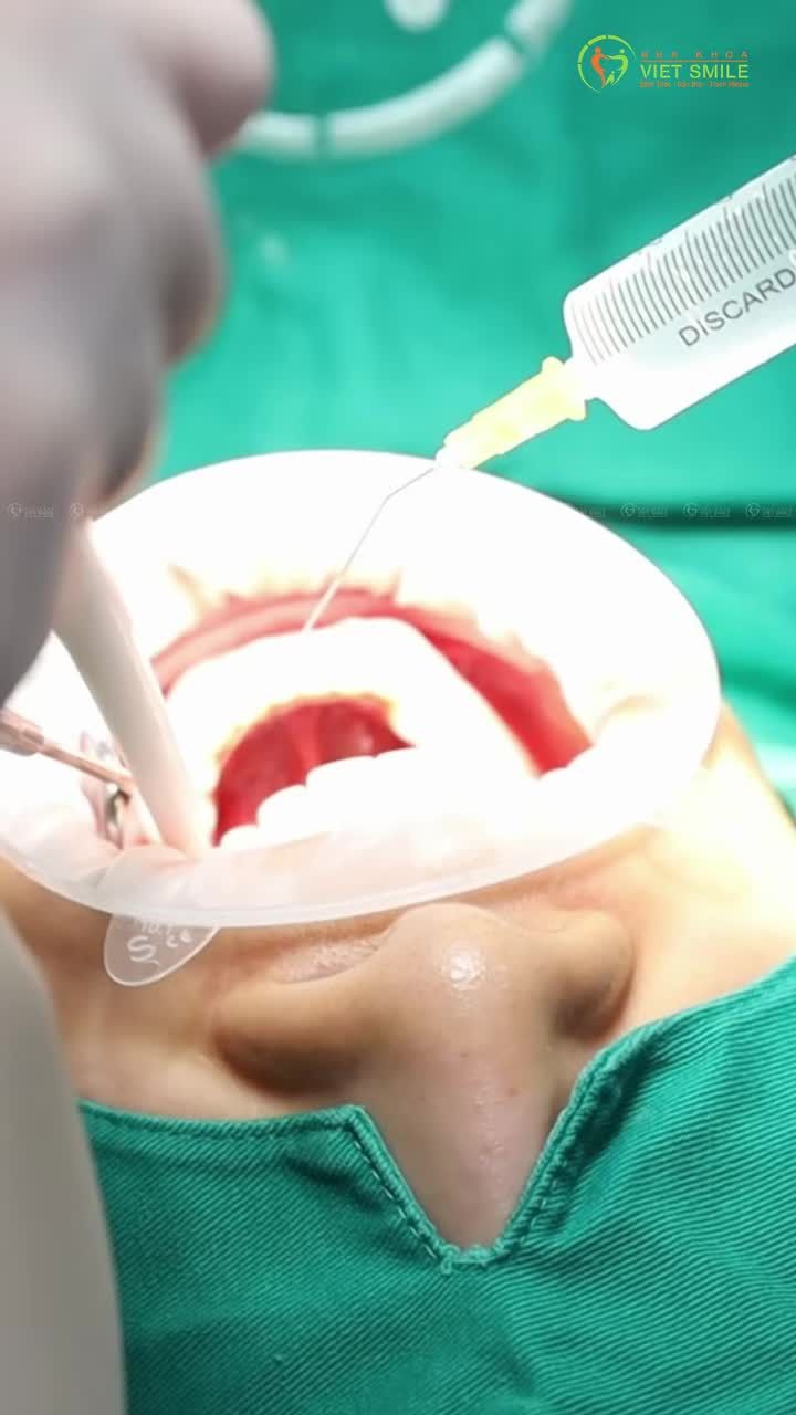 QUÁ TRÌNH CẤY GHÉP IMPLANT DIỄN RA THẾ NÀO?