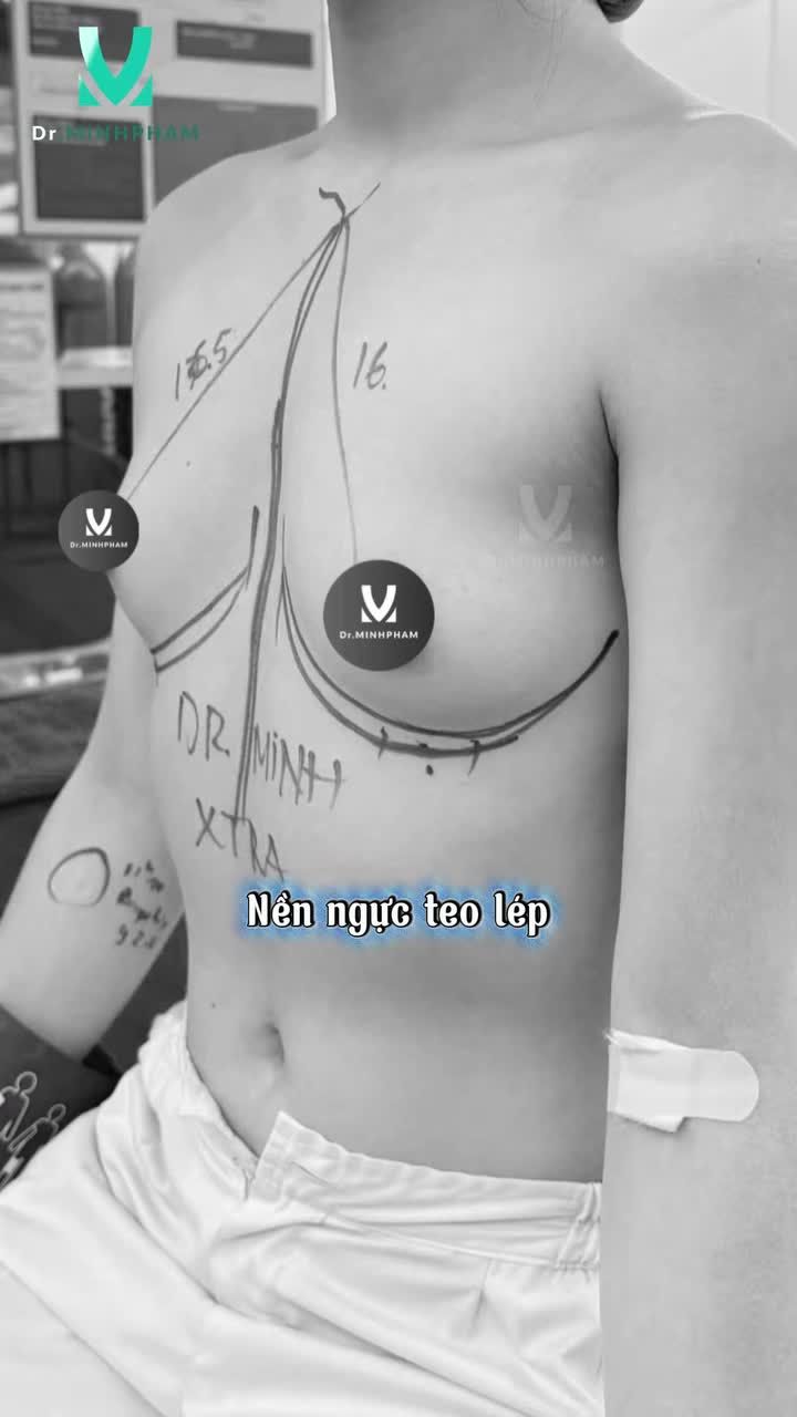 Tạm biệt diện mạo cũ với V1 teo lép