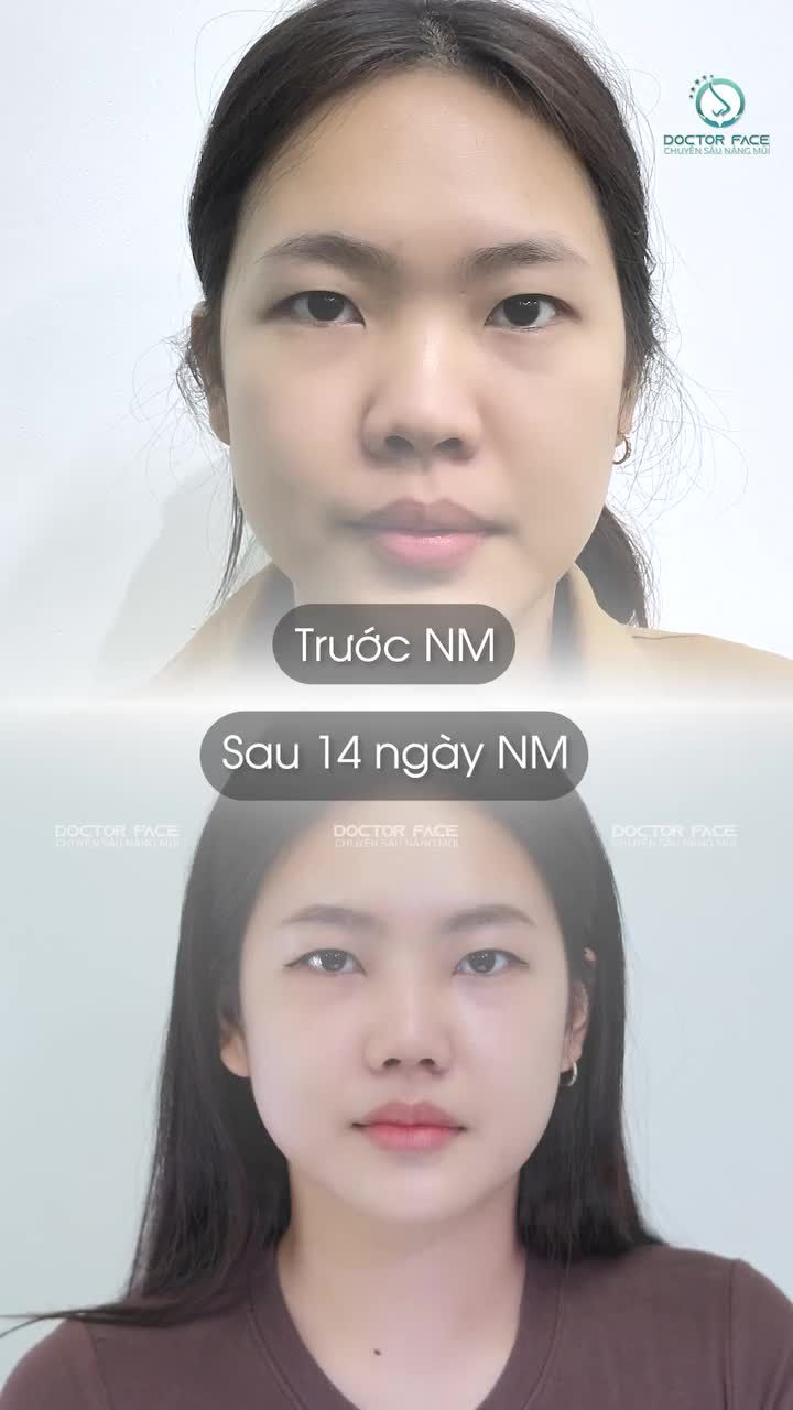 Sau 14 ngày, chị khách này vẫn nhớ như in phản ứng của mình trong lần đầu soi gương sau khi làm m.ũi xong. Và lý do phía sau khiến cả ekip hôm đó đều bất ngờ