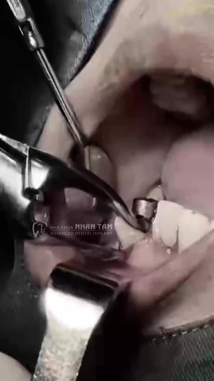NHỔ RĂNG VÀ CẤY GHÉP IMPLANT TRONG CÙNG 1 LẦN HẸN