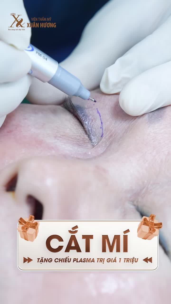 TRẺ HÓA ĐÔI MẮT VỚI COMBO CẮT MÍ TRÊN - DƯỚI