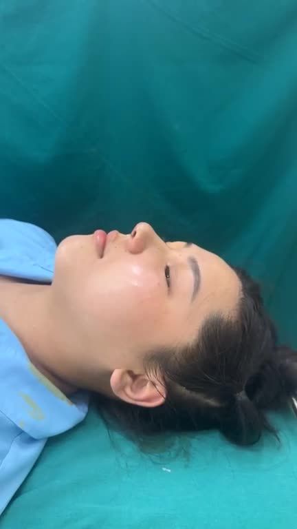 Mũi cấu trúc rút chỉ vừa hoàn thành