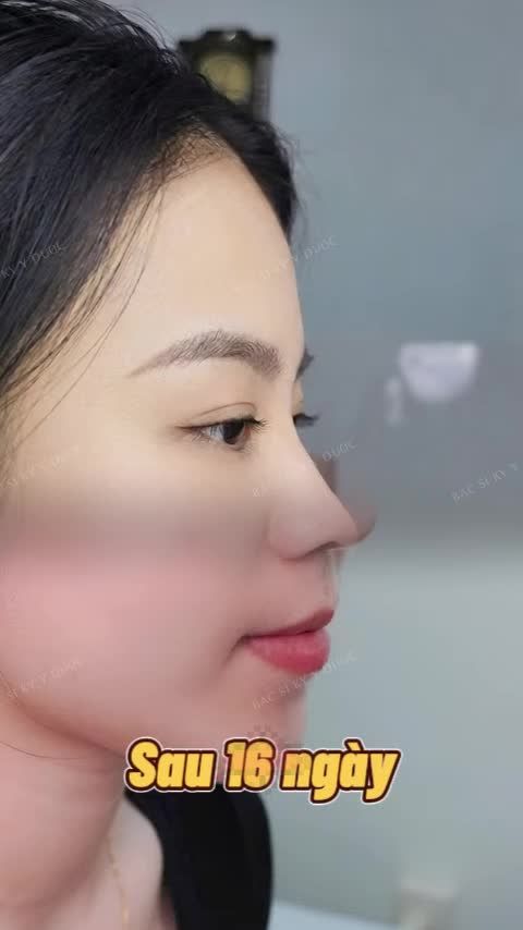 Dáng mũi sau 16 ngày trộm vía quá