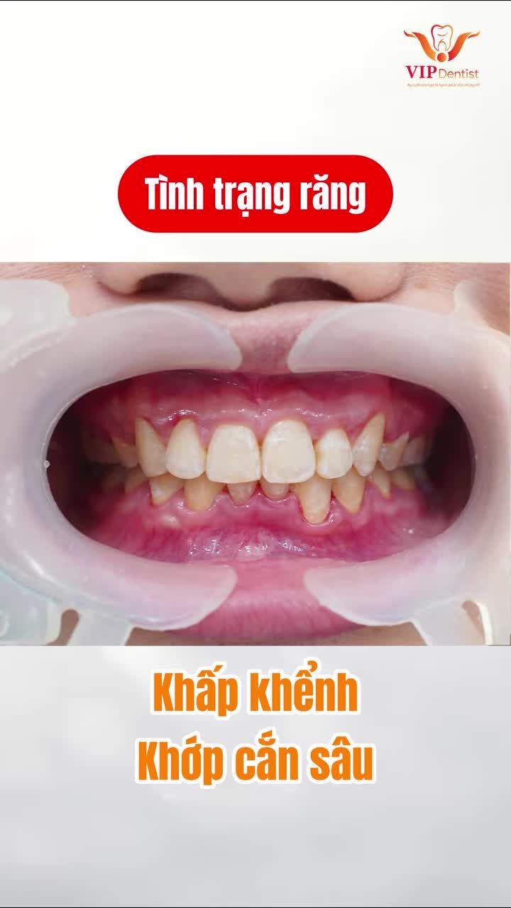 Tình trạng răng khấp khểnh nặng, khớp cắn sâu, khuôn mặt thiếu cân đối.
