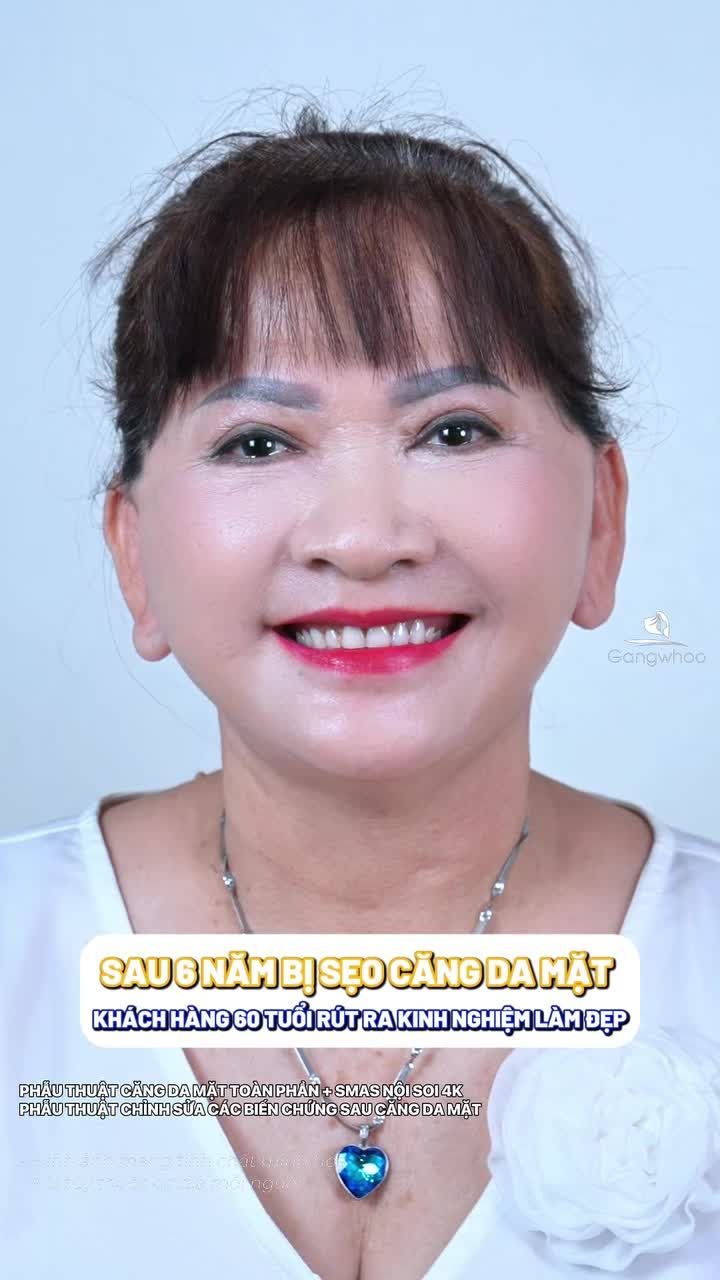 Sau 6 năm bị sẹo do căng da mặt nơi khác cô khách hàng 60 tuổi chia sẻ bí quyết lựa chọn cơ sở làm đẹp uy tín - tận tâm