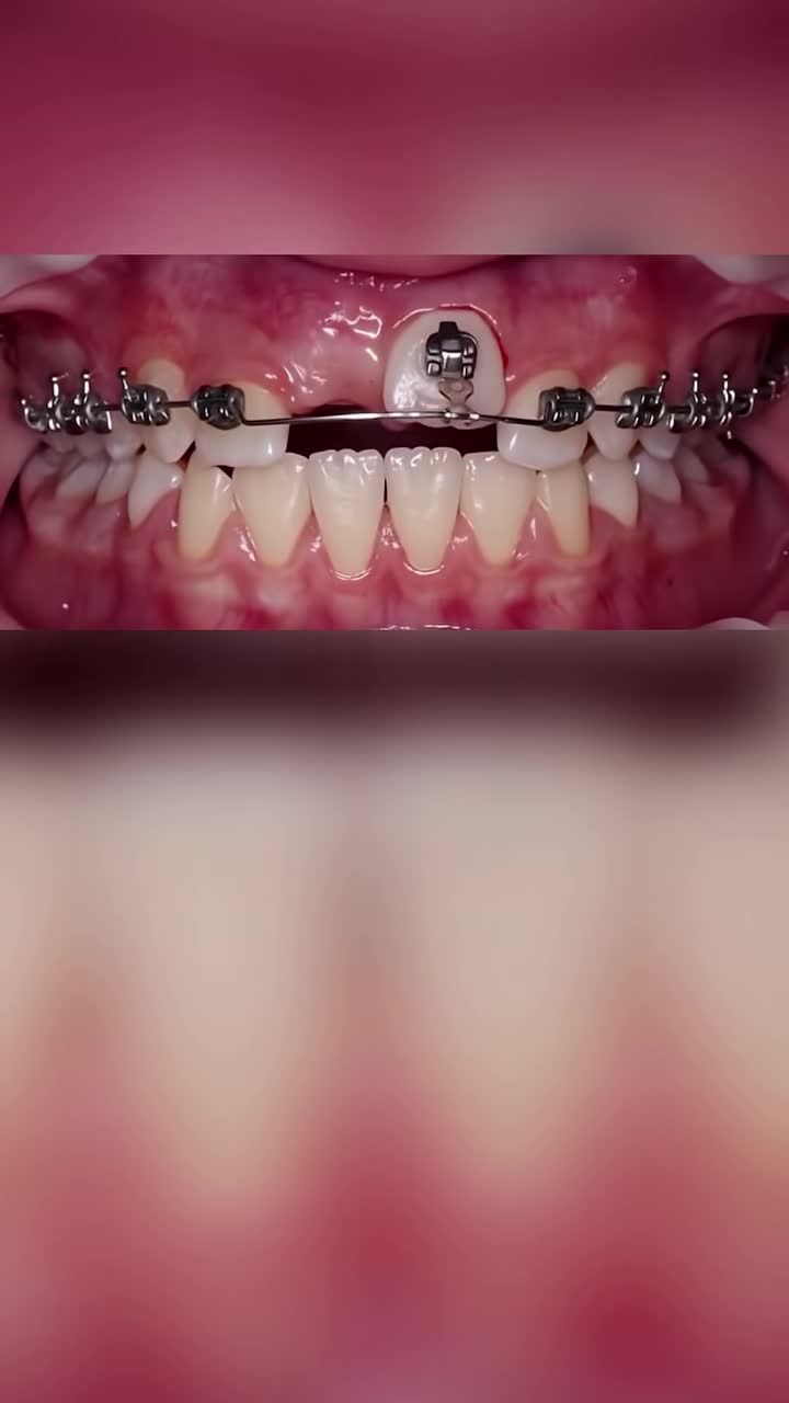 Kéo răng từ trong xương hàm