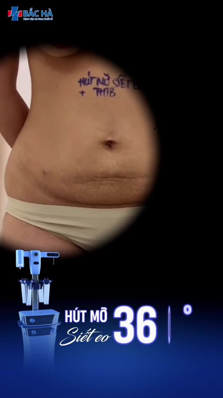SAU 3 THÁNG HÚT MỠ TẠO HÌNH THÀNH BỤNG
