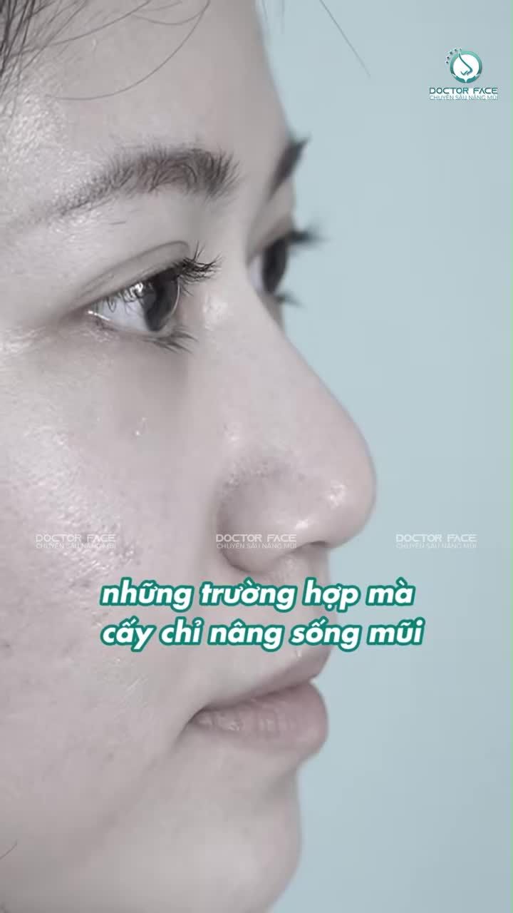 Cấy chỉ mũi không phải là không có hiệu quả đâu nha