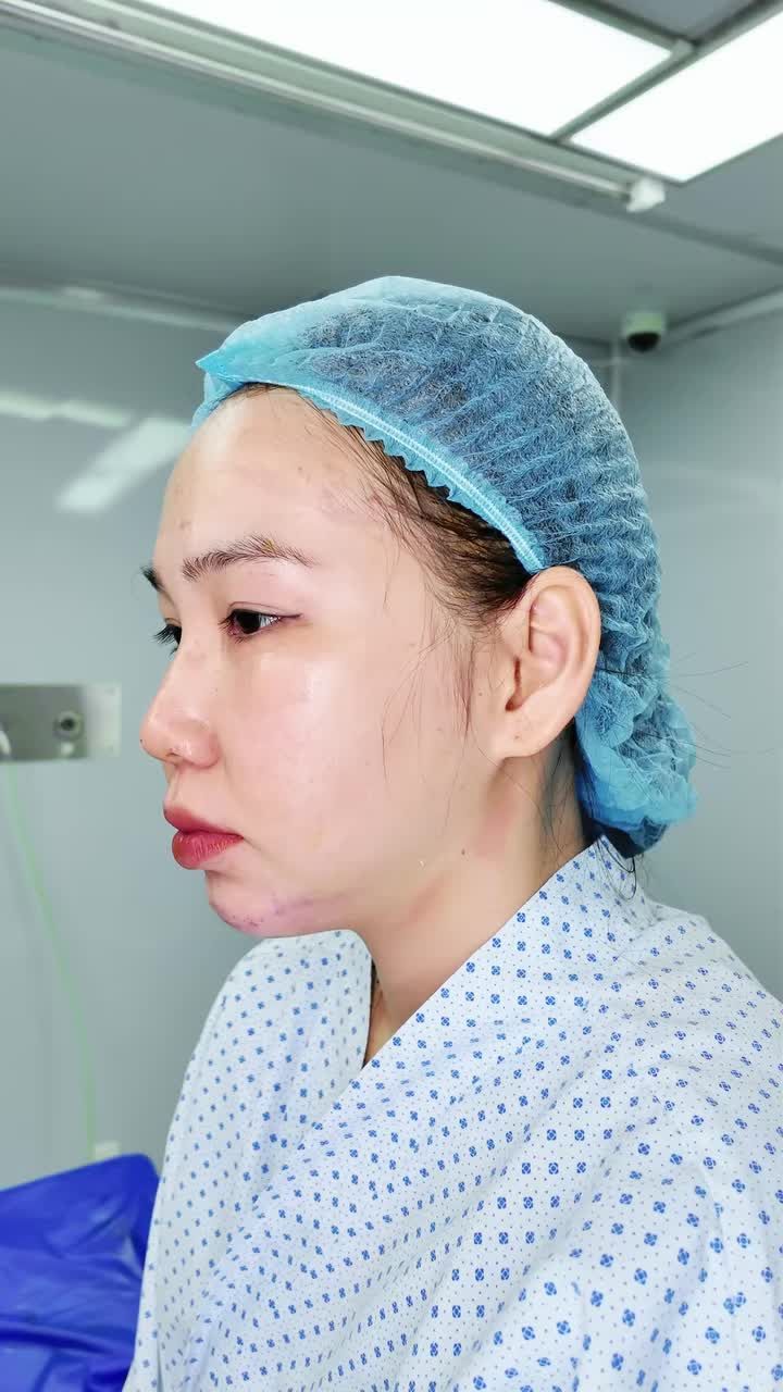 TẠI PHÒNG PHẪU THUẬT: DIỆN MẠO MỚI CỦA CÔ NÀNG 28 TUỔI ĐẾN TỪ BẠC LIÊU – ĐỘN CẰM NỘI SOI ĐẸP TỰ NHIÊN, KHẮC PHỤC HOÀN TOÀN CẰM LẸM!