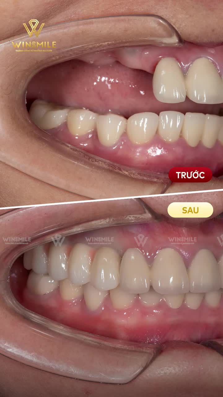 Trồng 04 implant thay thế khoảng mất răng lớn ở cung hàm 1, cô Vũ Thị Nhiễu lấy lại được cảm giác ăn nhai chắc chắn chỉ sau 1 buổi cấy và 5 tháng chờ tích hợp.