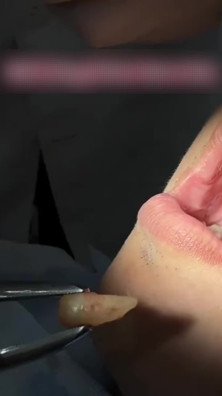 VÌ SAO NÊN NHỔ RĂNG KHÔN SỚM?