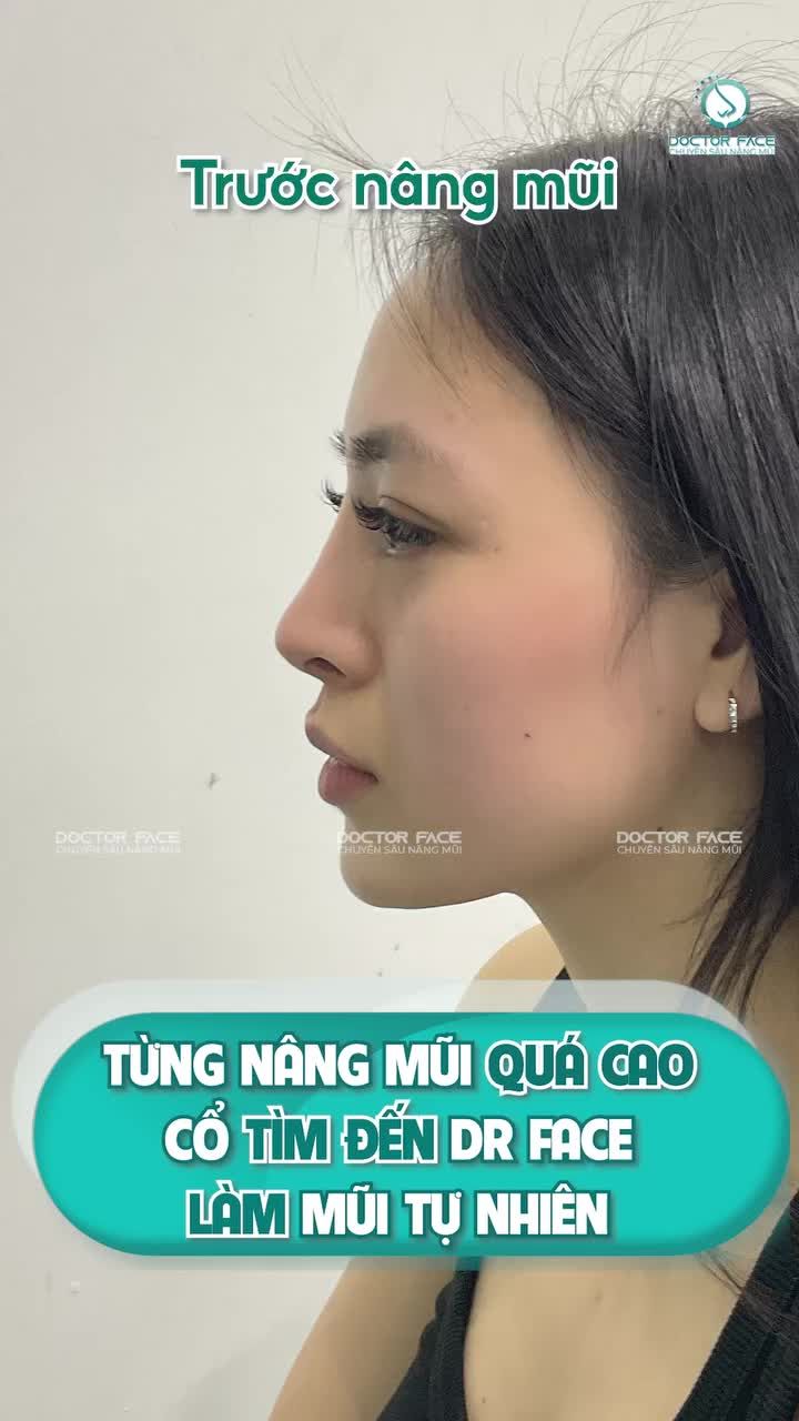 Từng làm m.ũi thật cao, giờ chị khách này lại thích dáng tự nhiên hơn