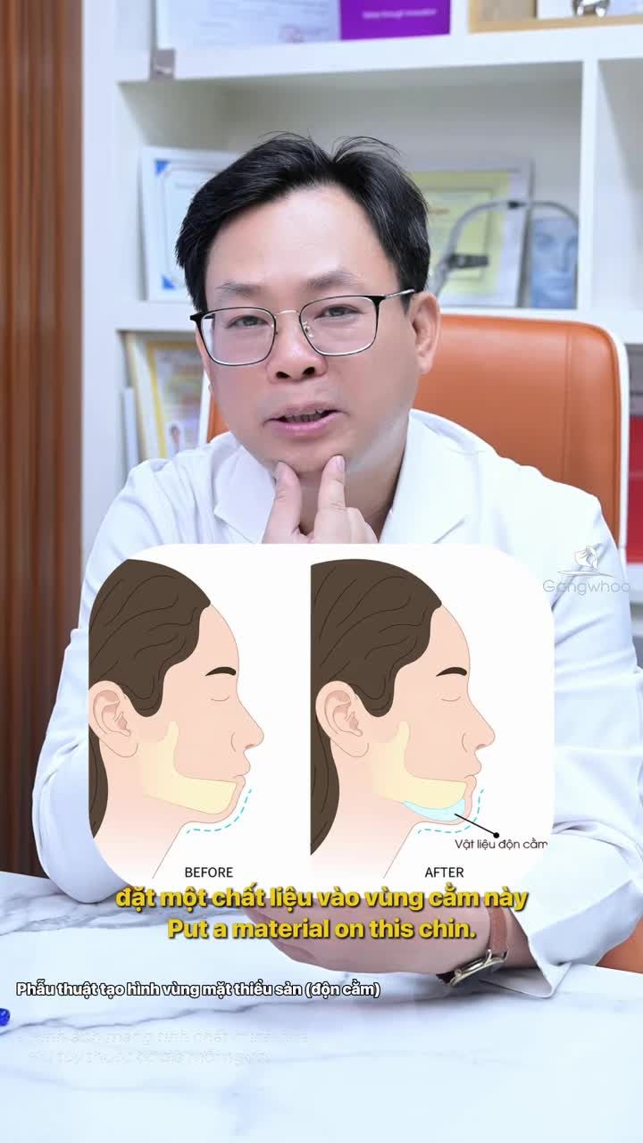 Tất tần tật về độn cằm: Những điều bạn cần biết trước khi làm