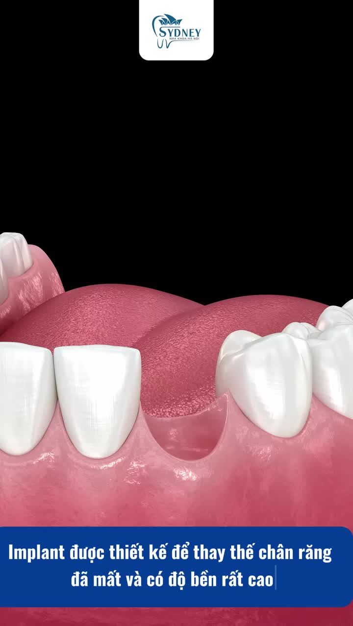 Răng Implant có sử dụng được vĩnh viễn không?