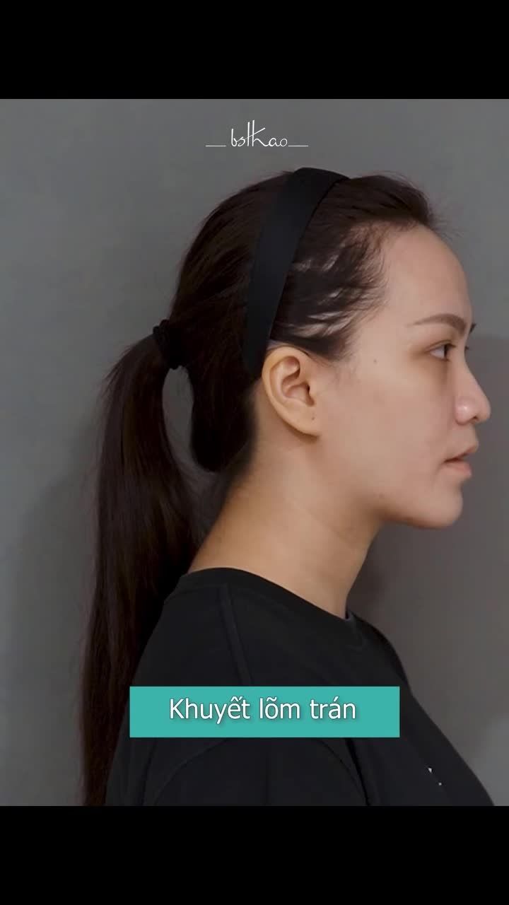 HẾT MẮT "GẤU TRÚC", CẰM NGẮN, KHUÔN MẶT THIẾU CÂN ĐỐI CHỈ NHỜ 1 PHƯƠNG PHÁP!