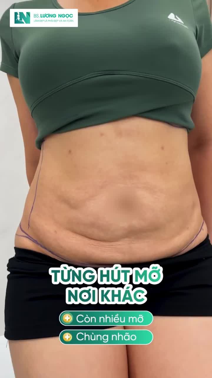 Chiếc bụng chưa như mong muốn sau lần thực hiện trước... Bác sĩ Lương Ngọc sẽ đánh giá tình trạng này ra sao và hướng xử lý như thế nào?
