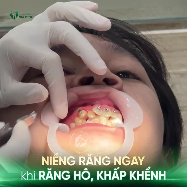 RĂNG HÔ, KHẤP KHỂNH? NIỀNG RĂNG NGAY TRONG MÙA HÈ NÀY!