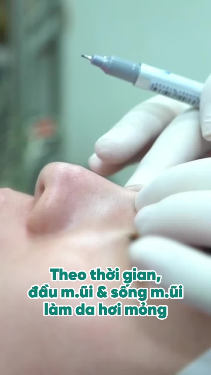 Loay hoay nhiều năm với dáng mũi lệch và đầu mũi ngày càng c.ụp. Đến khi gặp bs Phương, chị mới hiểu vì sao tình trạng này ngày càng rõ hơn theo thời gian.