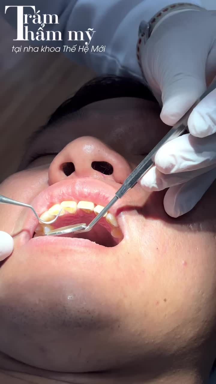 Chia sẻ cho các bạn qui trình làm 1 case trám răng thẩm mỹ tại nha khoa mình diễn ra như thế nào nhé