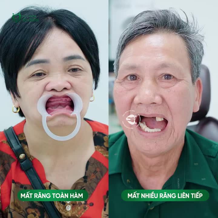 CÔ CHÚ MẤT RĂNG TOÀN HÀM -  ALL ON 4, ALL ON 6 LÀ GIẢI PHÁP PHỤC HỒI HIỆU QUẢ