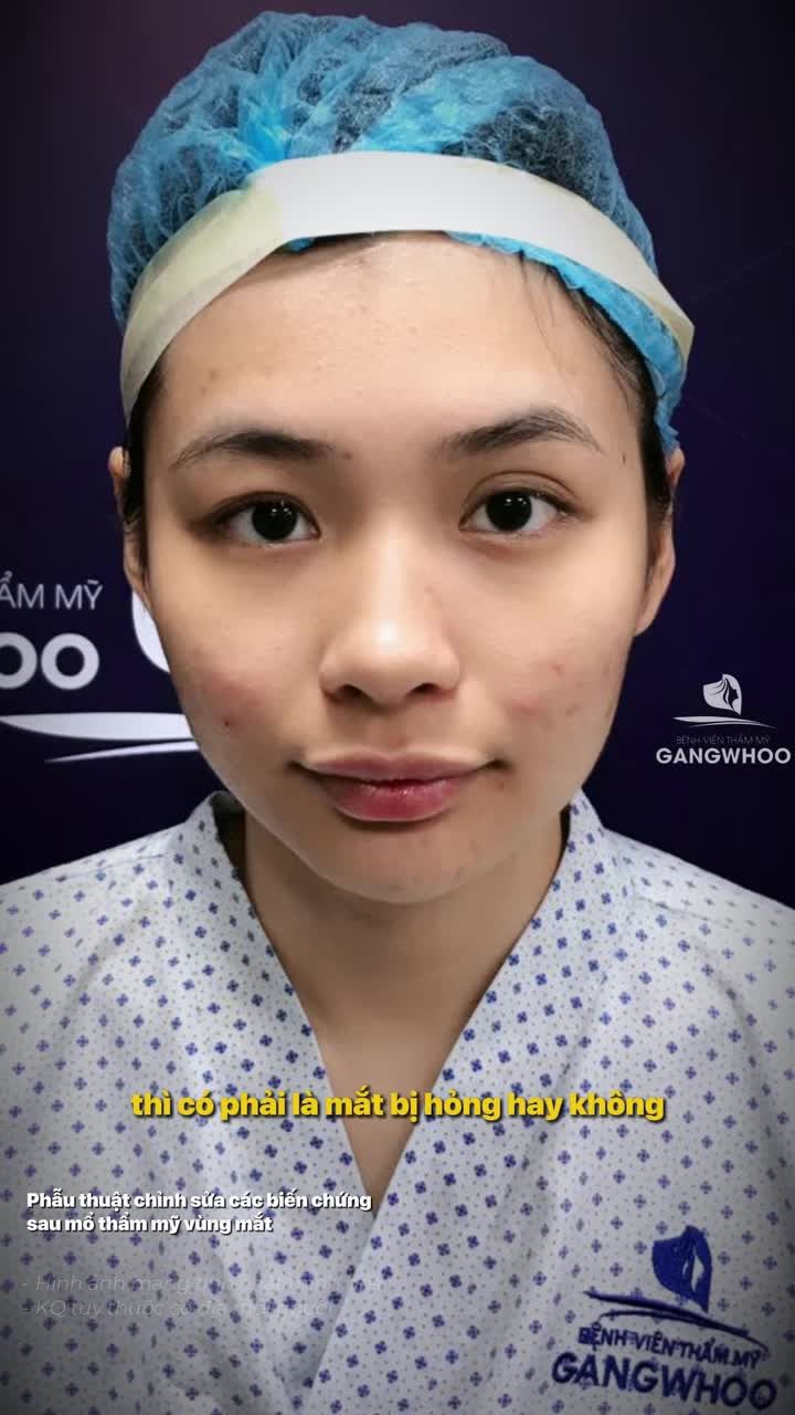Cắt mí xong nhưng nếp mí quá to, hai bên không đều, mắt trợn hoặc kết quả không như mong đợi... Bao lâu mới có thể sửa lại?
