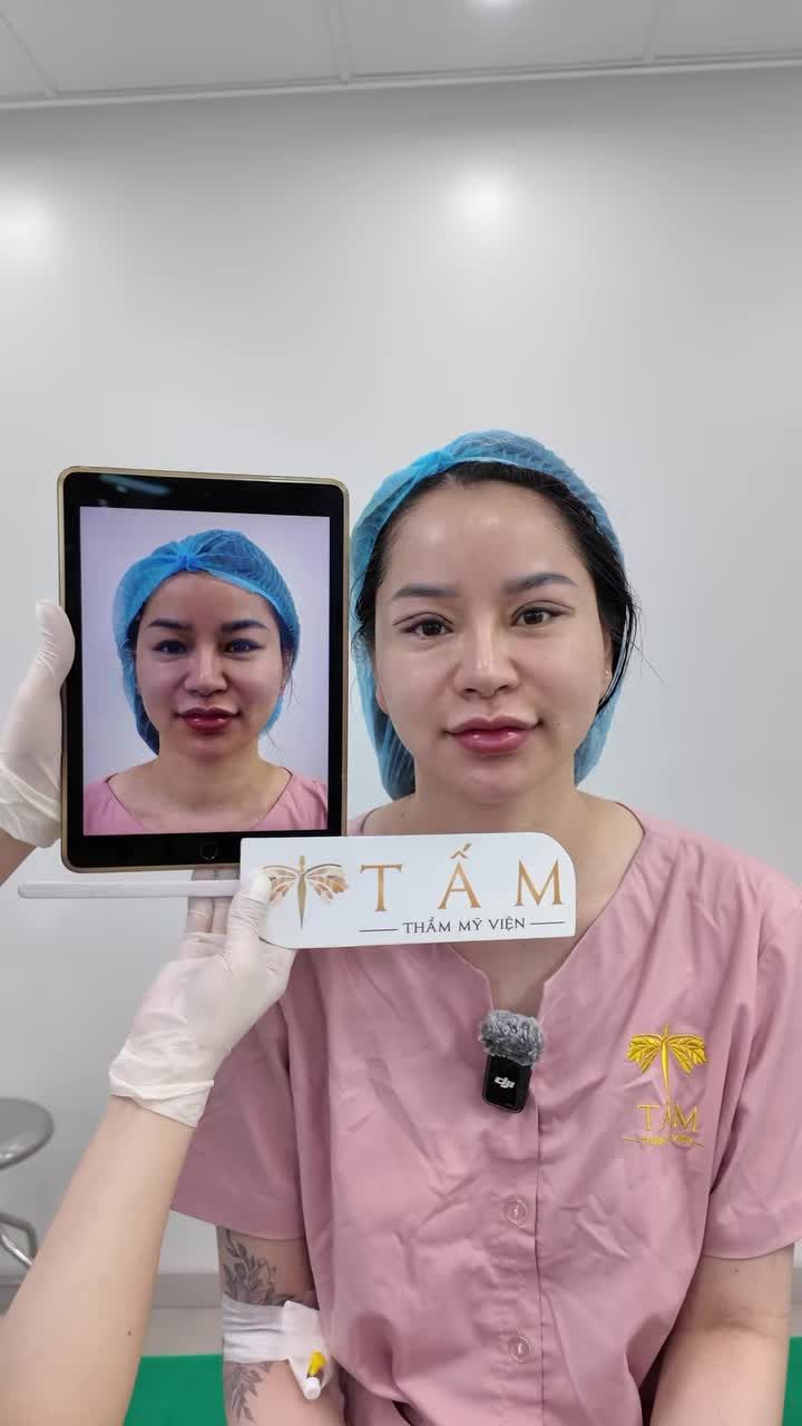 Cùng xem trực tiếp hình ảnh khách hàng đến từ Hải Dương qua TMV Tấm thực hiện dịch vụ Cắt mí Shanghai.