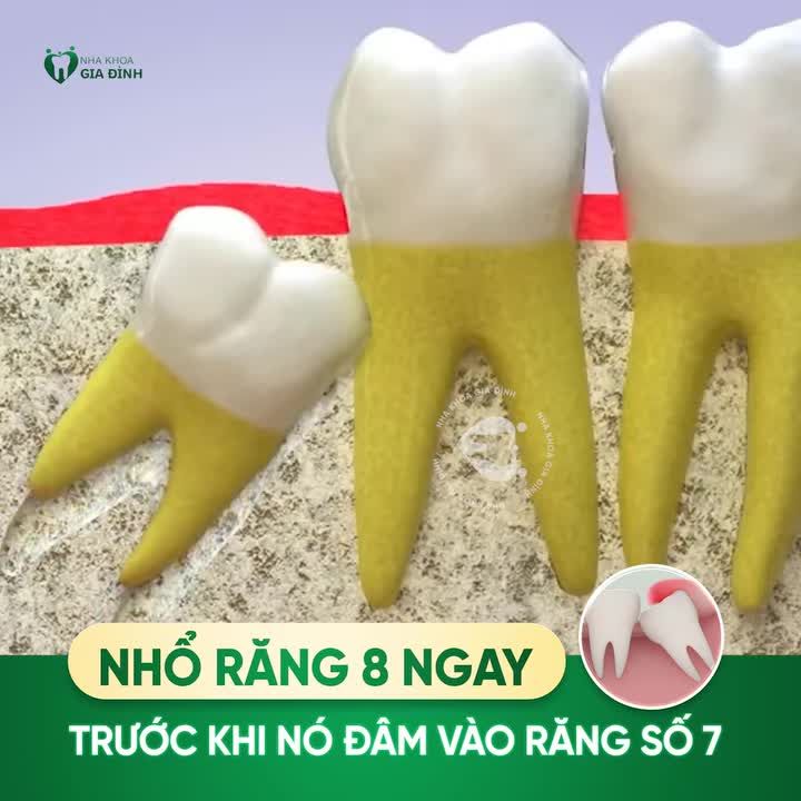 NHỔ RĂNG SỐ 8 NGAY TRƯỚC KHI NÓ ĐÂM VÀO RĂNG SỐ 7