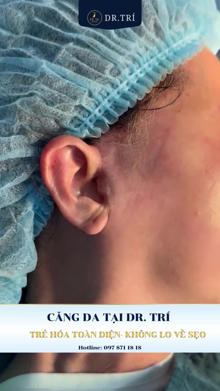 KẾT QUẢ THỰC TẾ: 3 THÁNG CĂNG DA MẶT TẠI DR. TRÍ